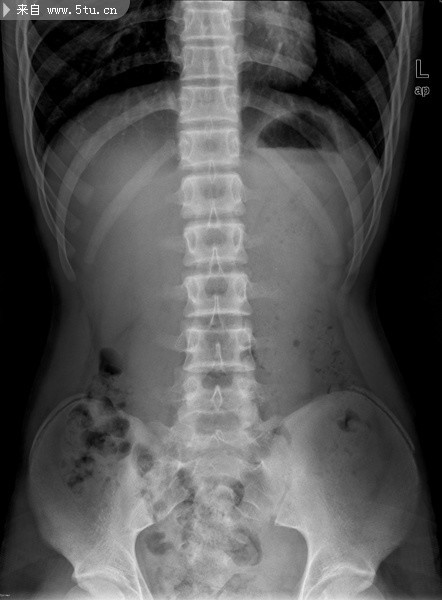 高清腹部X光片图片