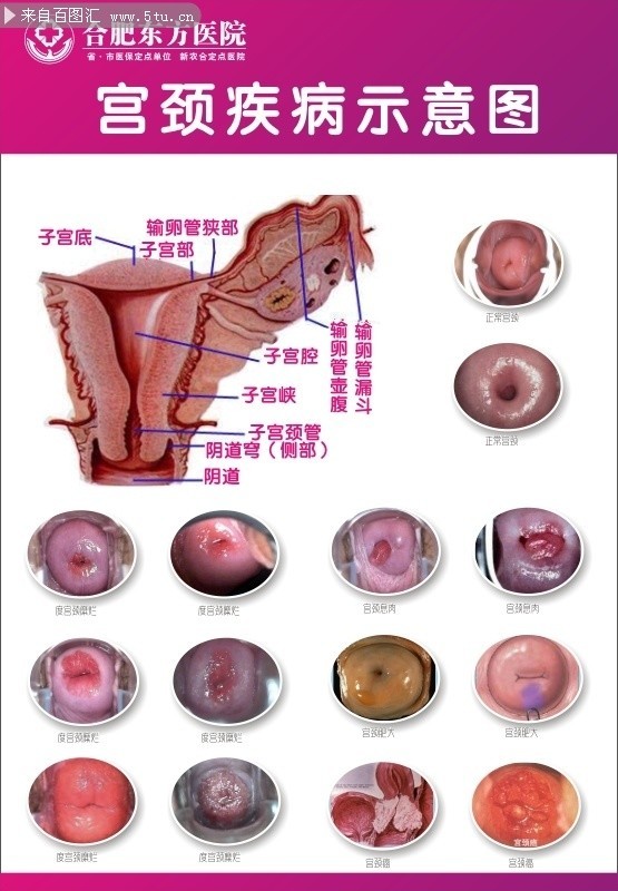 宫颈疾病示意图素材下载
