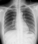 人体X光胸片图 医学片子大图